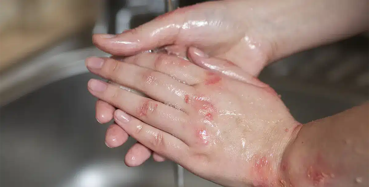 Chemical Burn Injuries